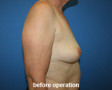 plastic-surgery-breast-augmentation